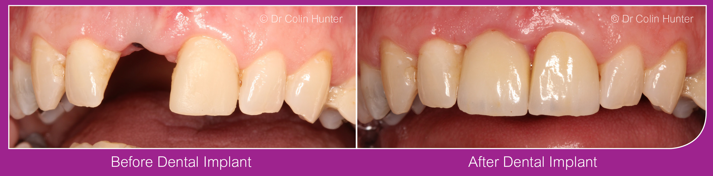 Dental Implants Kilbirnie, Beith, Dalry